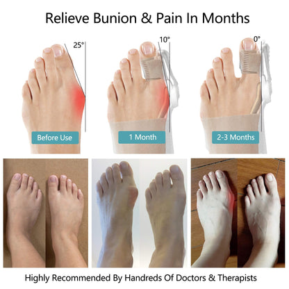 🔥Big Promotion 49% OFF💥Orthopedic Bunion Corrector