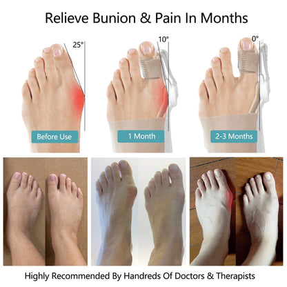 🔥Big Promotion 49% OFF💥Orthopedic Bunion Corrector - stavogue