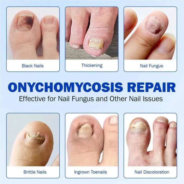 Nail Health Care Patches, Nail Fungus Care Patches, Suitable for Solving Fungal Nails and Other Nail Problems（21 Patches） - stavogue